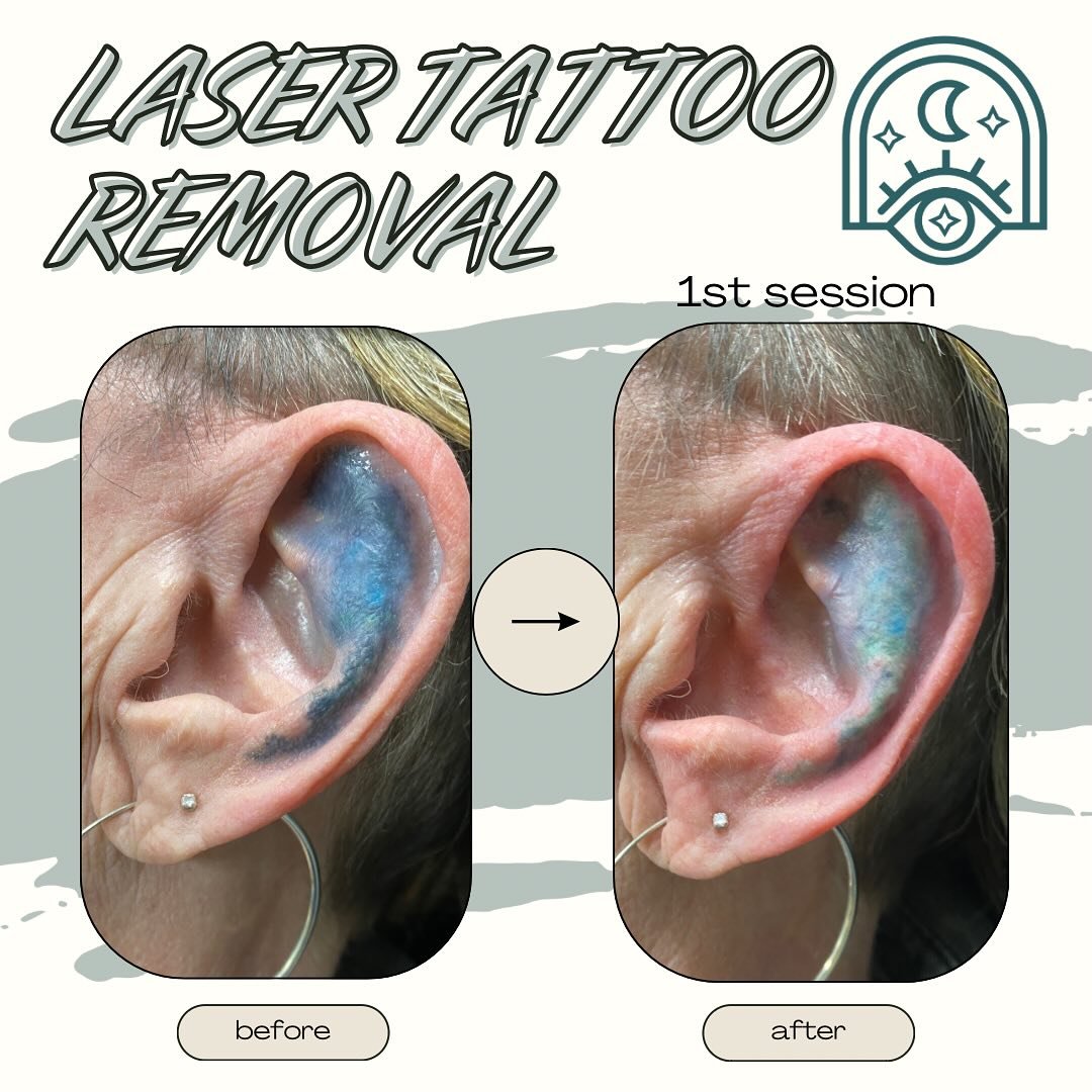 Laser tattoo removal can be quicker when the tattoo is older!

Now is the time to get removal before summer!

Link to book is in my bio 🫶🏼

🌞

🌞

🌞
#tattooremoval #tattoo #lasertattooremoval #laser #skincare #beauty #laserhairremoval #microbladi
