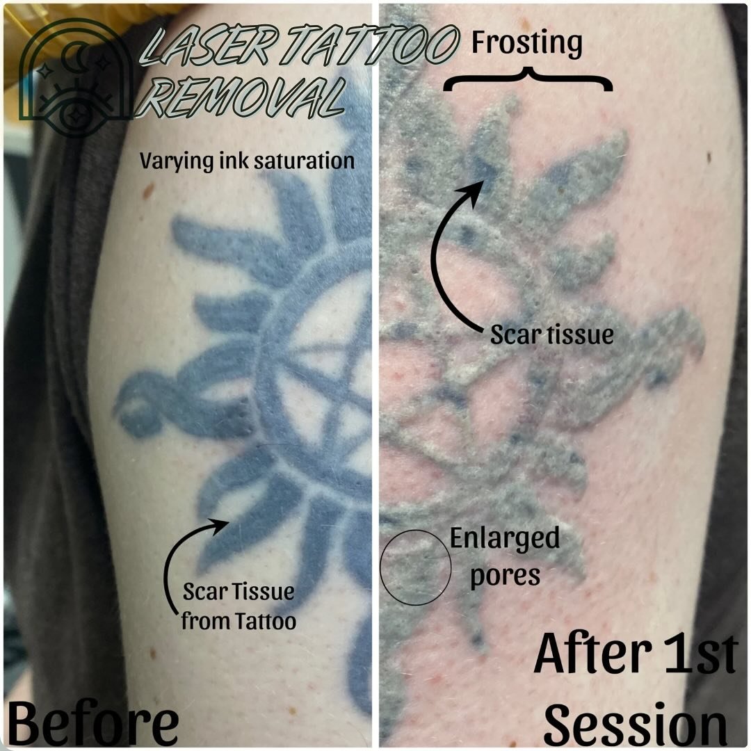 A little before and after 🫶🏻

Some things that can affect how fast tattoos can be removed include:

🤞🏼 SATURATION - how dark the tattoo is

🤞🏼 DEPTH - how deep did the artist go? Is there scarring?

🤞🏼 LOCATION - tattoos are cleared by your i
