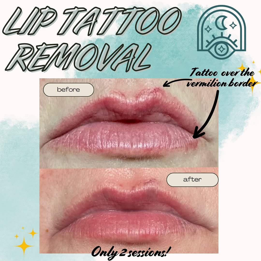 Are you ready for a clean slate for new permanent makeup? ❤️&zwj;🩹 

Book today!! 

Link is in my bio! 💗

#lasertattooremoval #laserliptattooremoval #permanentmakeupremoval #laserremovalbeforeandafter #beforeandafter