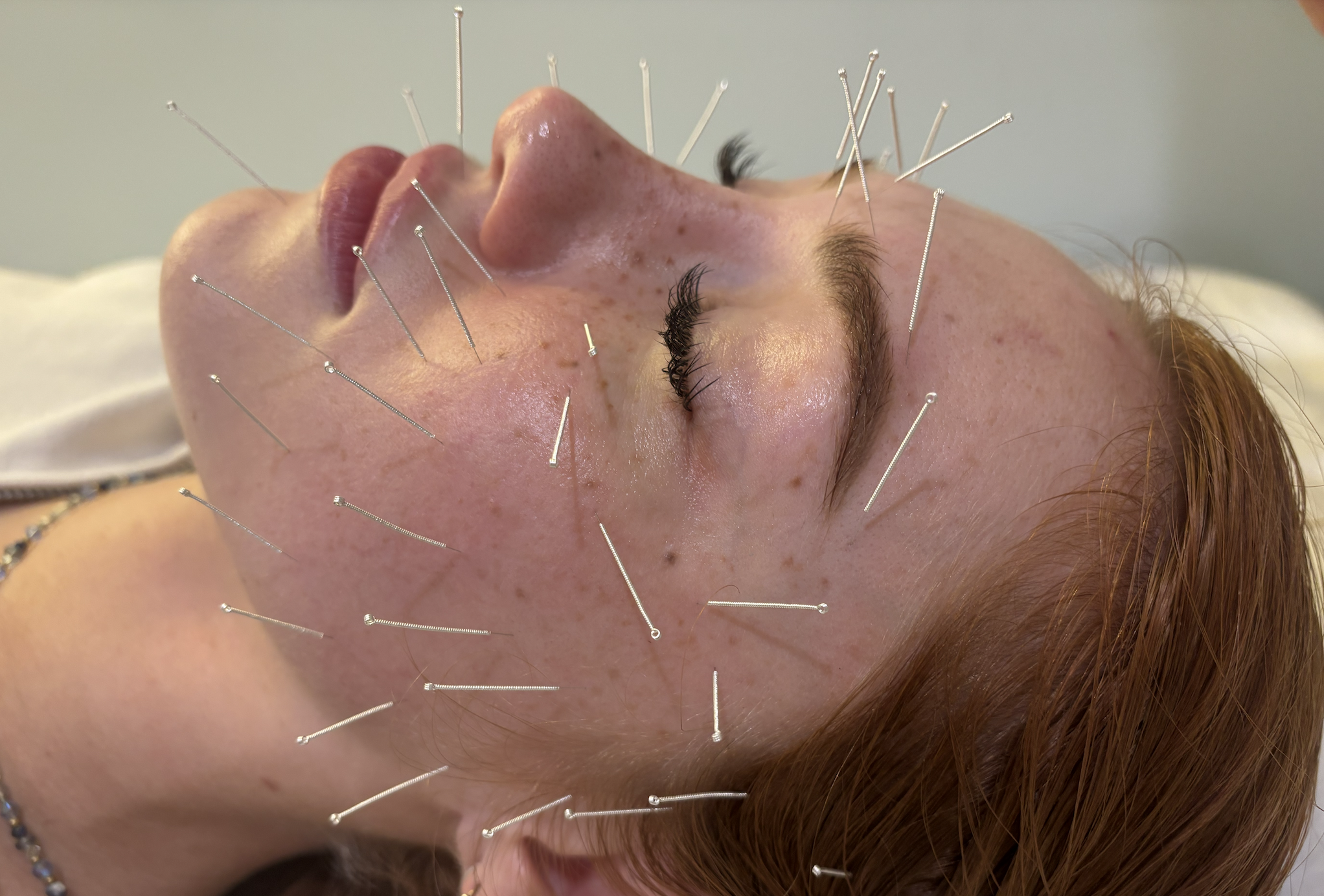 Temporomandibular Joint Dysfunction