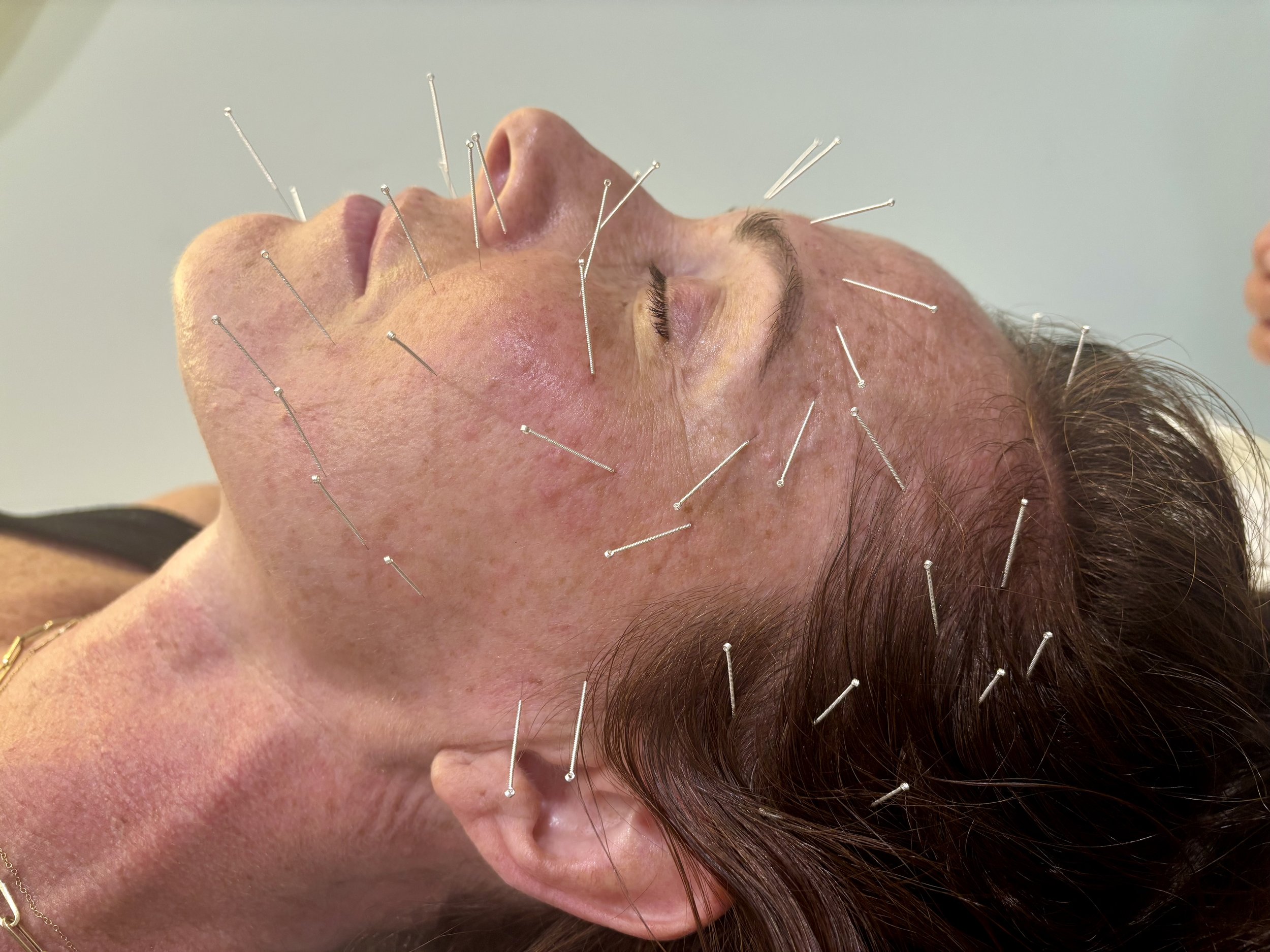 Hormonal Acne and Skin ProblemsWhat May Be Happening Beneath the Surface