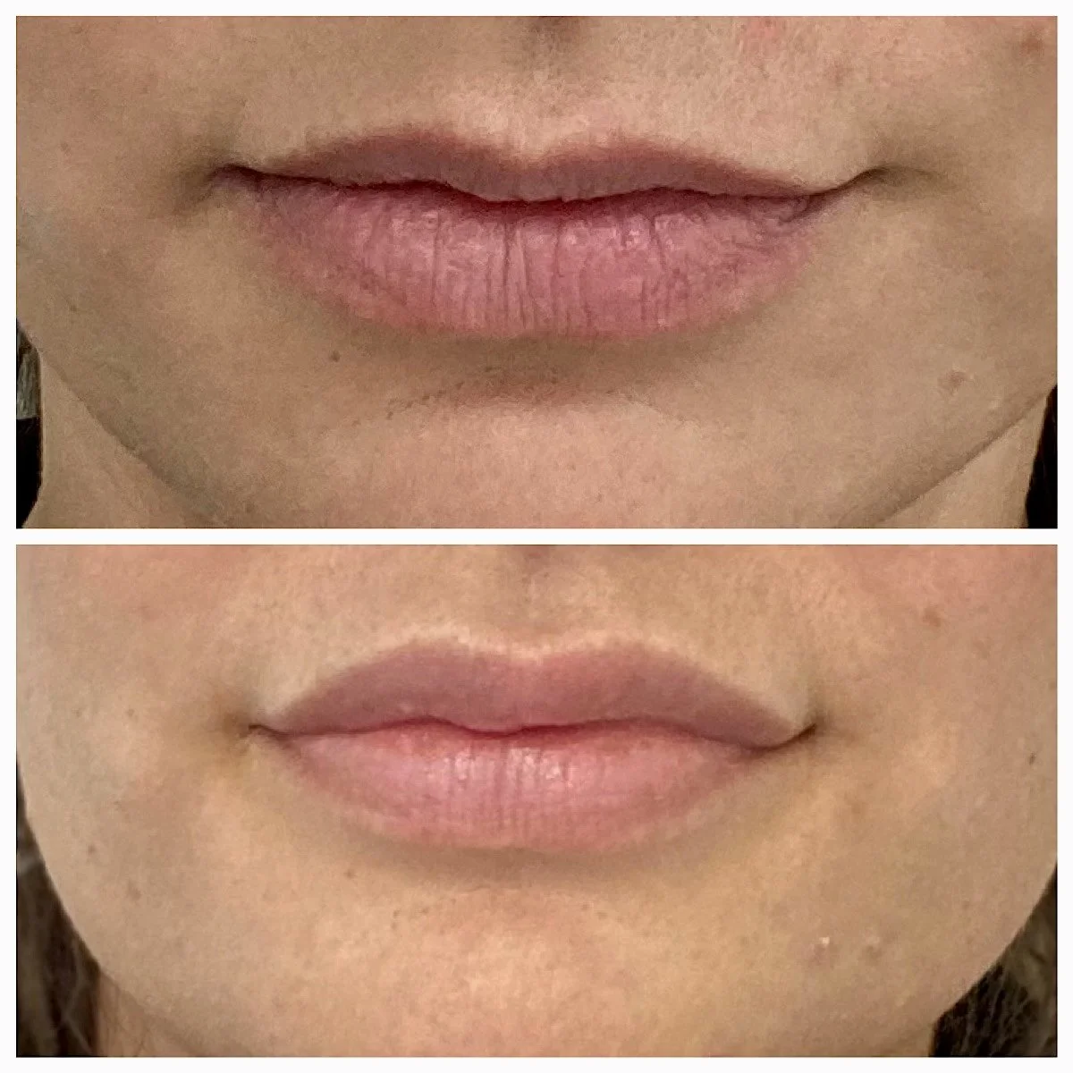 Nahaufnahme von zwei Lippenpaaren in einem Vorher-Nachher-Vergleich. Oben sind die Lippen weniger voll, unten wirken sie nach einer möglichen Behandlung voller.