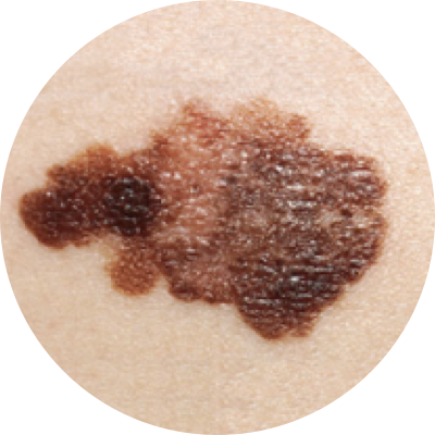 Melanoma skin example