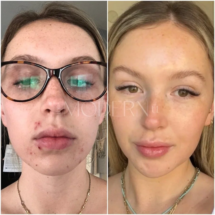 Side-by-side comparison of a woman with acne and freckles before and after skincare, showing clear skin and freckles.