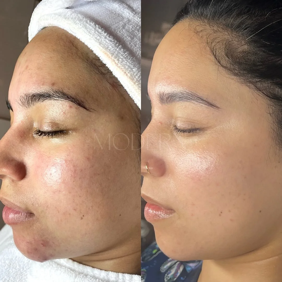 Training the skin to grow stronger and healthier takes time 🌱 patience and consistency goes hand in hand. 

Through trial and error we learned her skin does best with a simple routine. A few key player products that helped transform:
DMK Acu Masque
