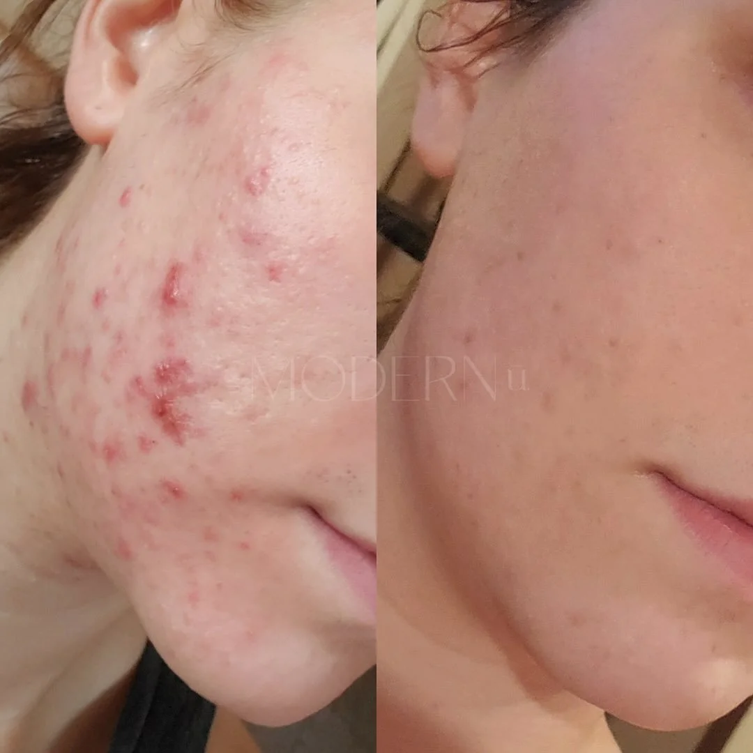 Healing skin from 3,000 miles away 🫶🏼

This client started her virtual skin journey with me in March and here we are today. Clearing acne from a distance is possible when you&rsquo;re consistently &ldquo;training&rdquo; the skin by adjusting lifest