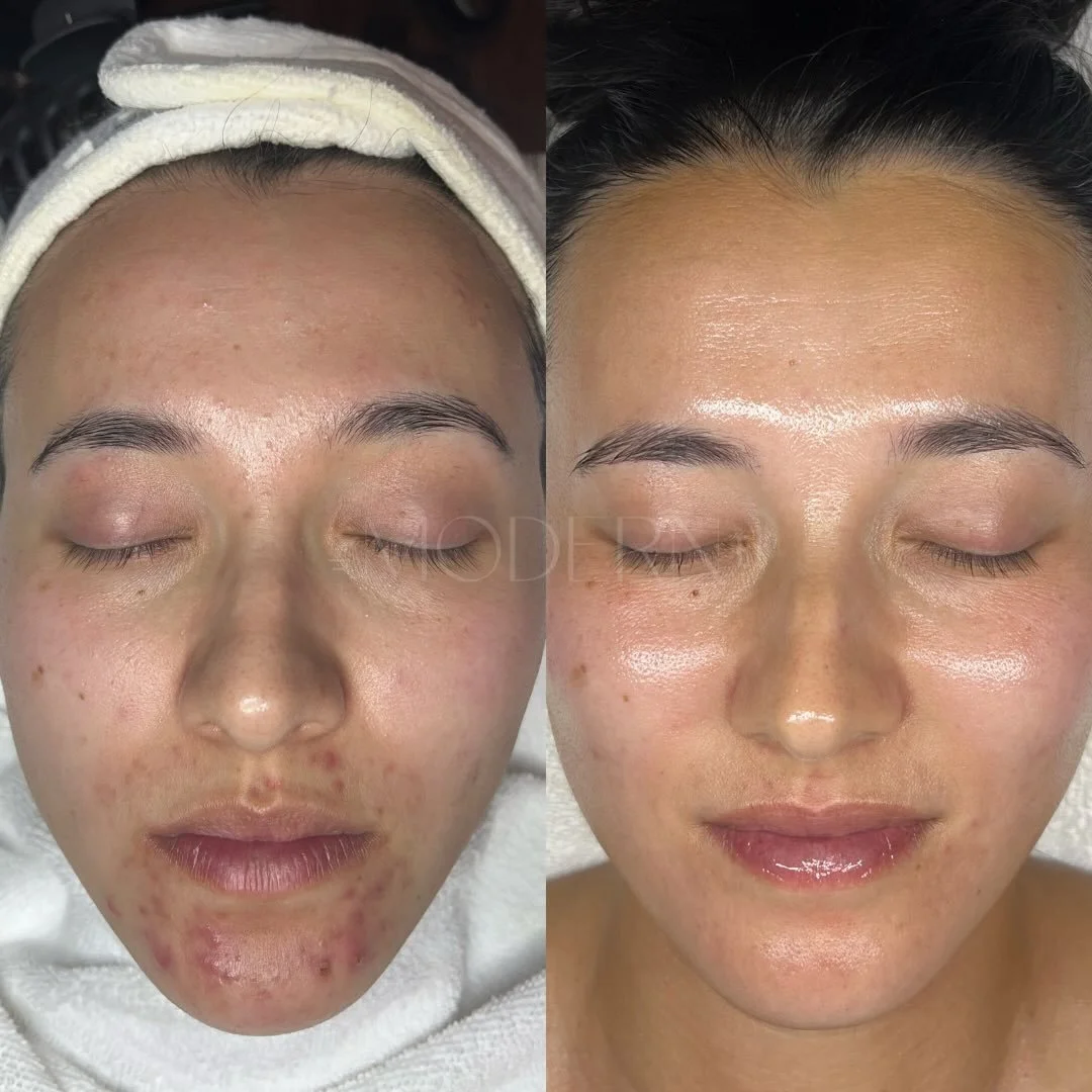 My top skin transformation of 2025 🏆✨ It was honestly hard to choose one, but this client takes the cake because we went on quite a journey together. At one point she said, &ldquo;If you told me to eat dog shit to clear my skin, I would do it.&rdquo