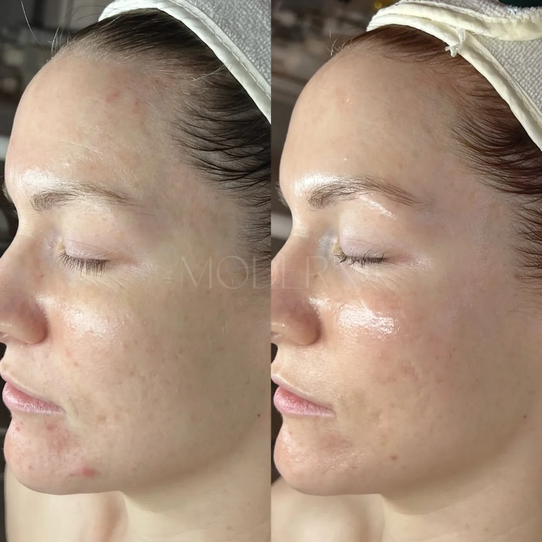 Barrier repair 🤝 collagen support. She&rsquo;s wedding-ready 💞

If you&rsquo;re prepping for your big day, I highly recommend starting treatments 6&ndash;12 months beforehand!