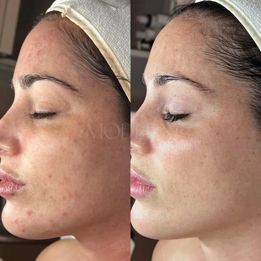 Client feedback like this is truly the heart of everything I do at The Modern Ū. It&rsquo;s what keeps me inspired. I just love watching the skin transform&mdash;slowly, intentionally peeling back the layers with care and consistency🌹 

Because we d