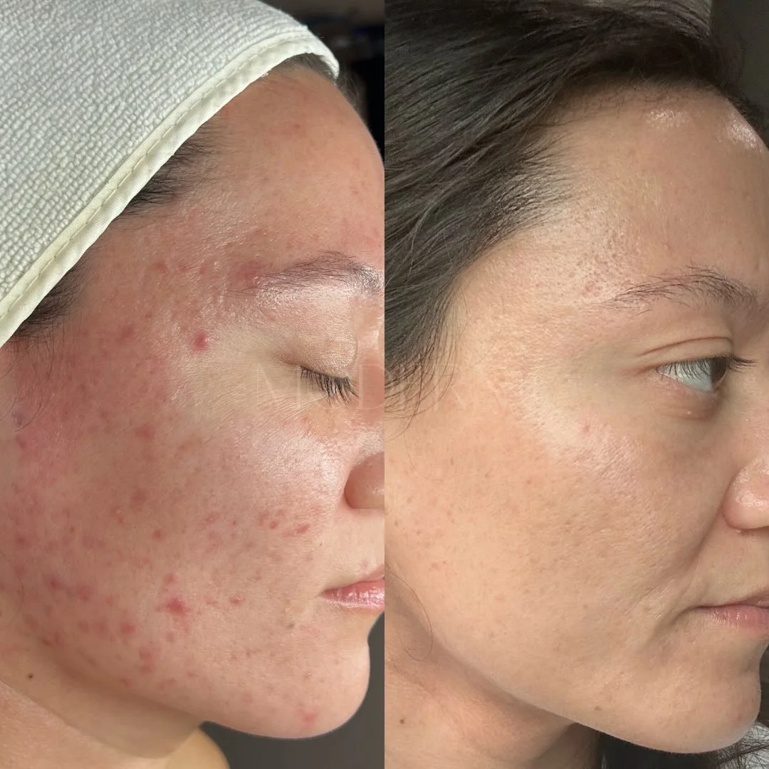 6 month transformation: just 2 facials with perfectly customized homecare and we&rsquo;re golden ⭐️

Heavy hitters in her routine are ~ 
DMK BP 10 Lotion - antibacterial
DMK Beta Gel - calming hydration 
DMK Actrol Powder - oil balance 
Vivant Derm-A