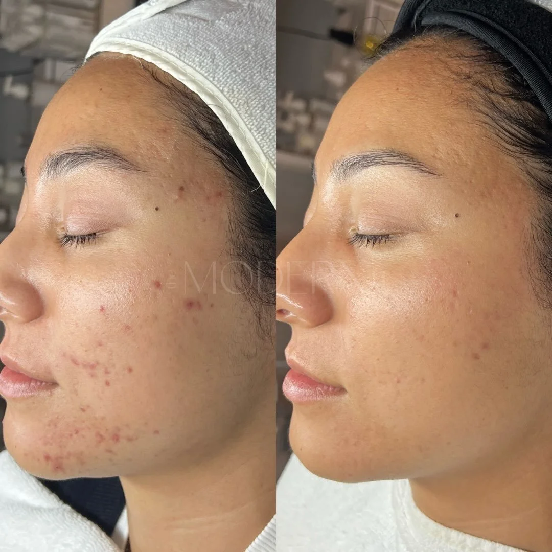 PIE / Post Inflammatory Erythema &mdash; not every mark left behind after acne is a scar. There are a few different things you can be left with when an acne lesion heals: pitted scarring, where there has been structural damage and collagen loss; PIH 