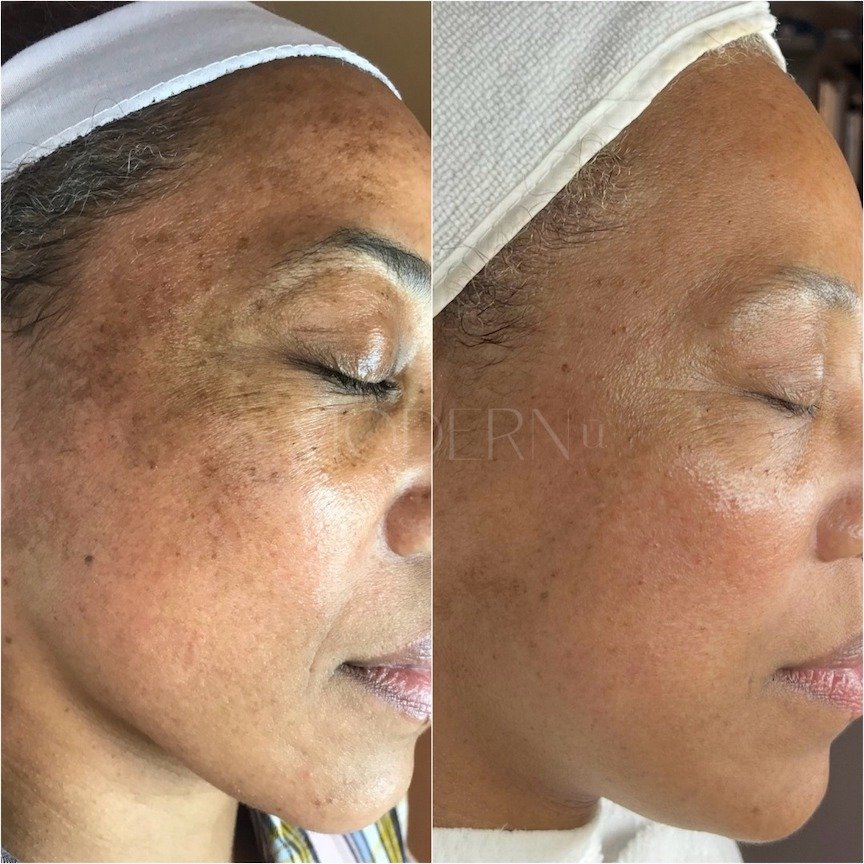 Side-by-side comparison of a woman's face before and after skincare treatment, showing significant reduction in dark spots and hyperpigmentation.