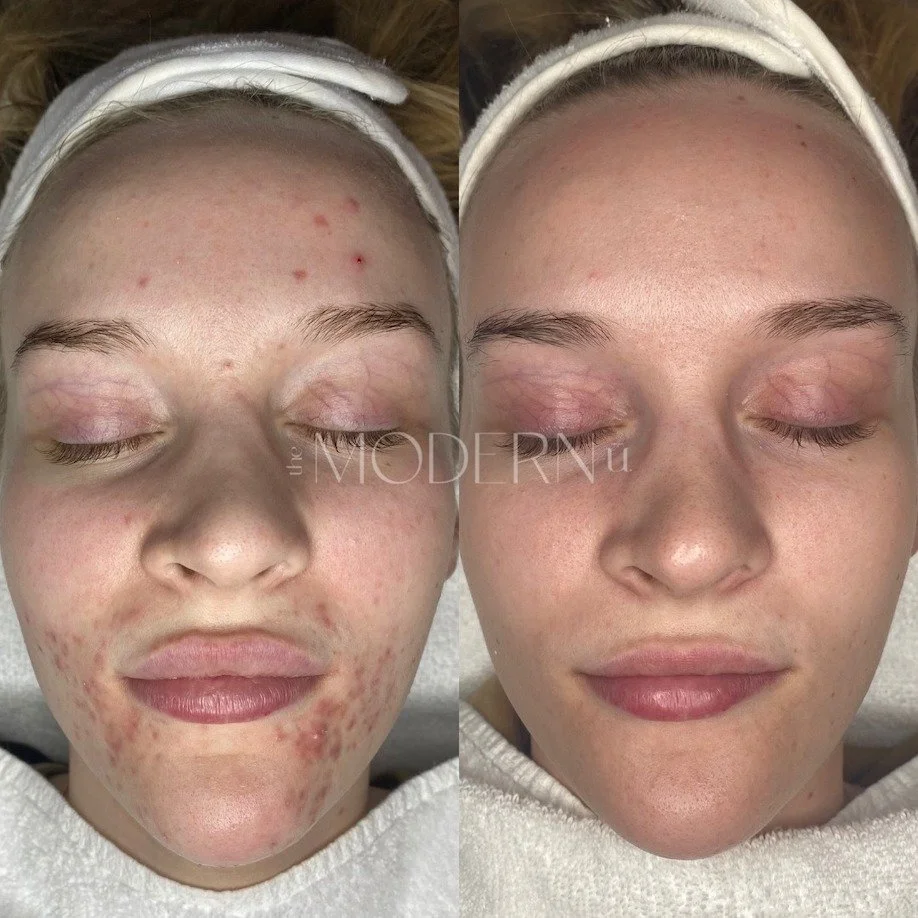 Side-by-side of a woman with acne before and after skincare treatment, showing clear skin on the right.