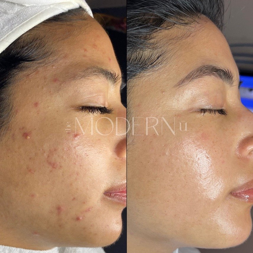 Side-by-side comparison of a woman's face before and after skincare treatment, showing clearer skin and reduced blemishes in the after photo.