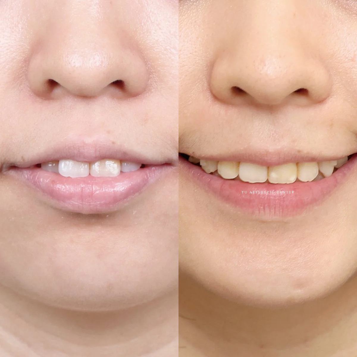 隱形矯正｜改善暴牙、嘴凸、齒列凌亂