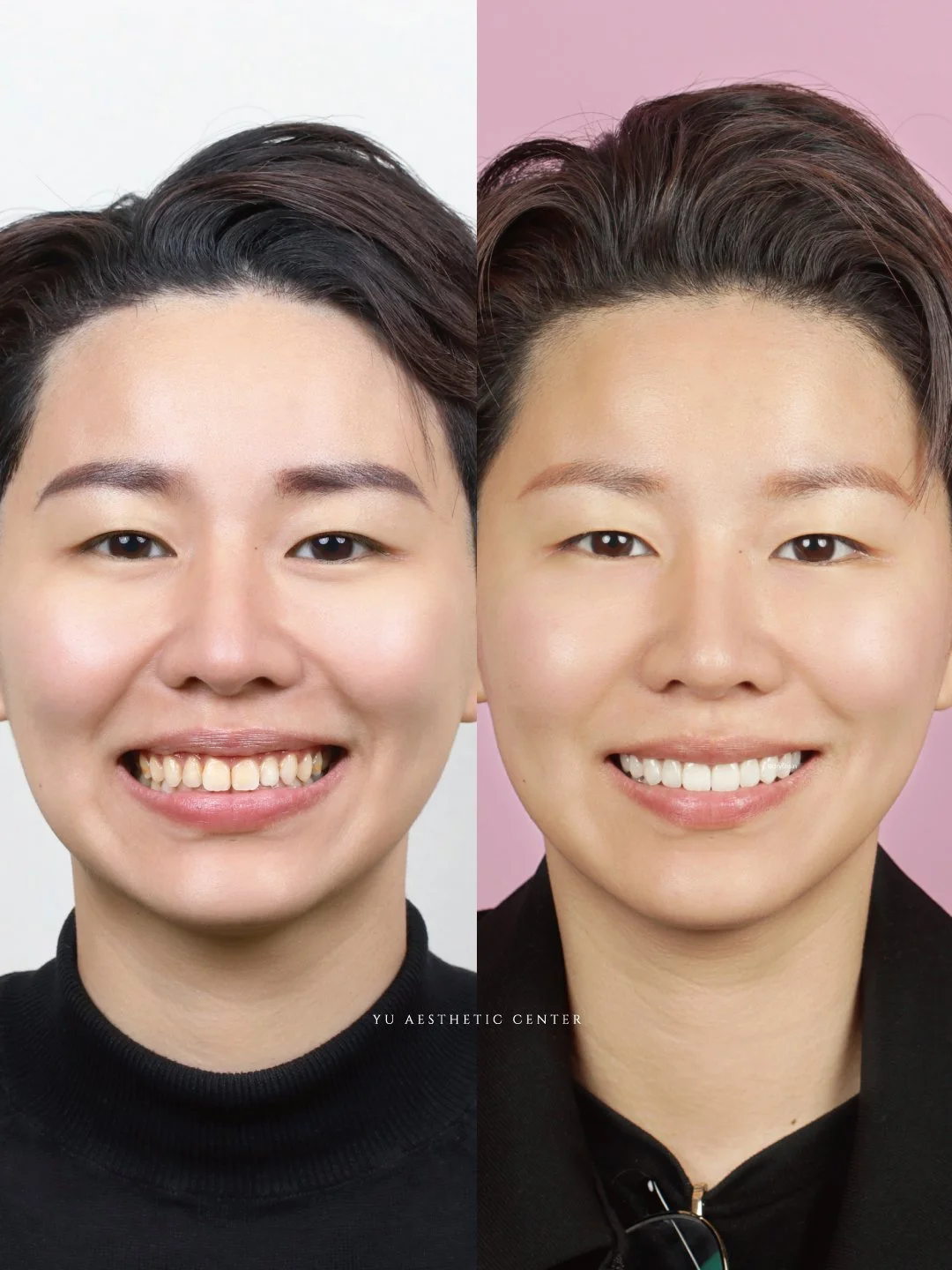 隱適美輕矯正 × 原生陶瓷貼片