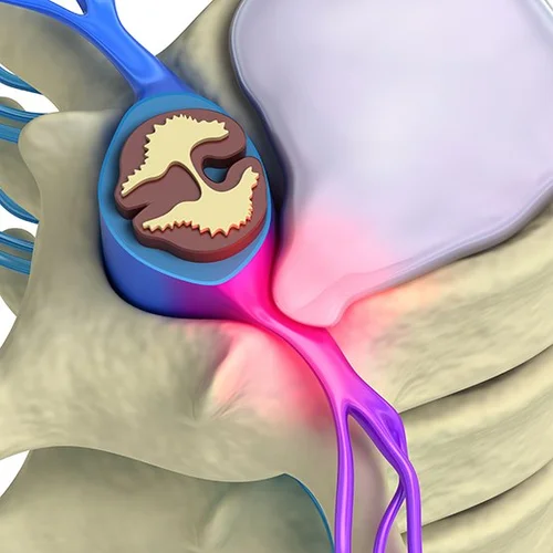 Pinched Nerve Relief: Chiropractic Help - Structure Carlsbad — Carlsbad ...