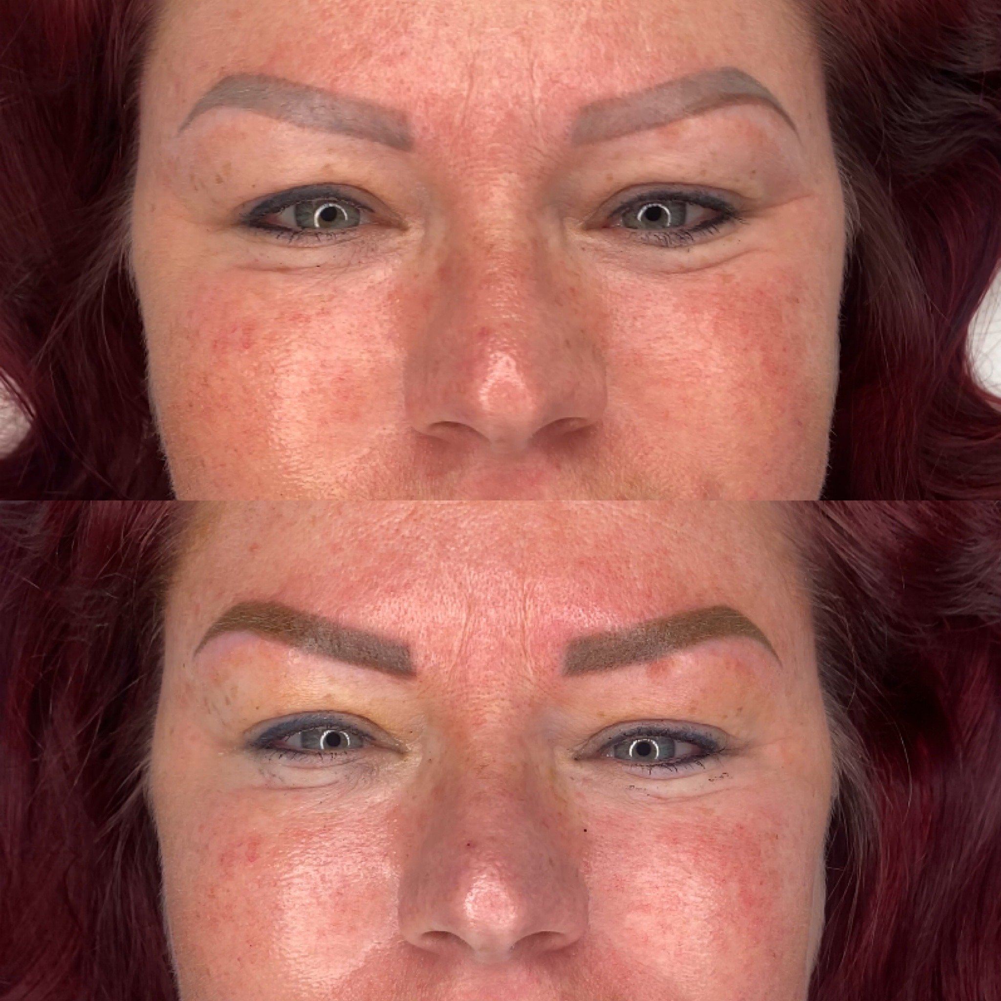 Brow Correction