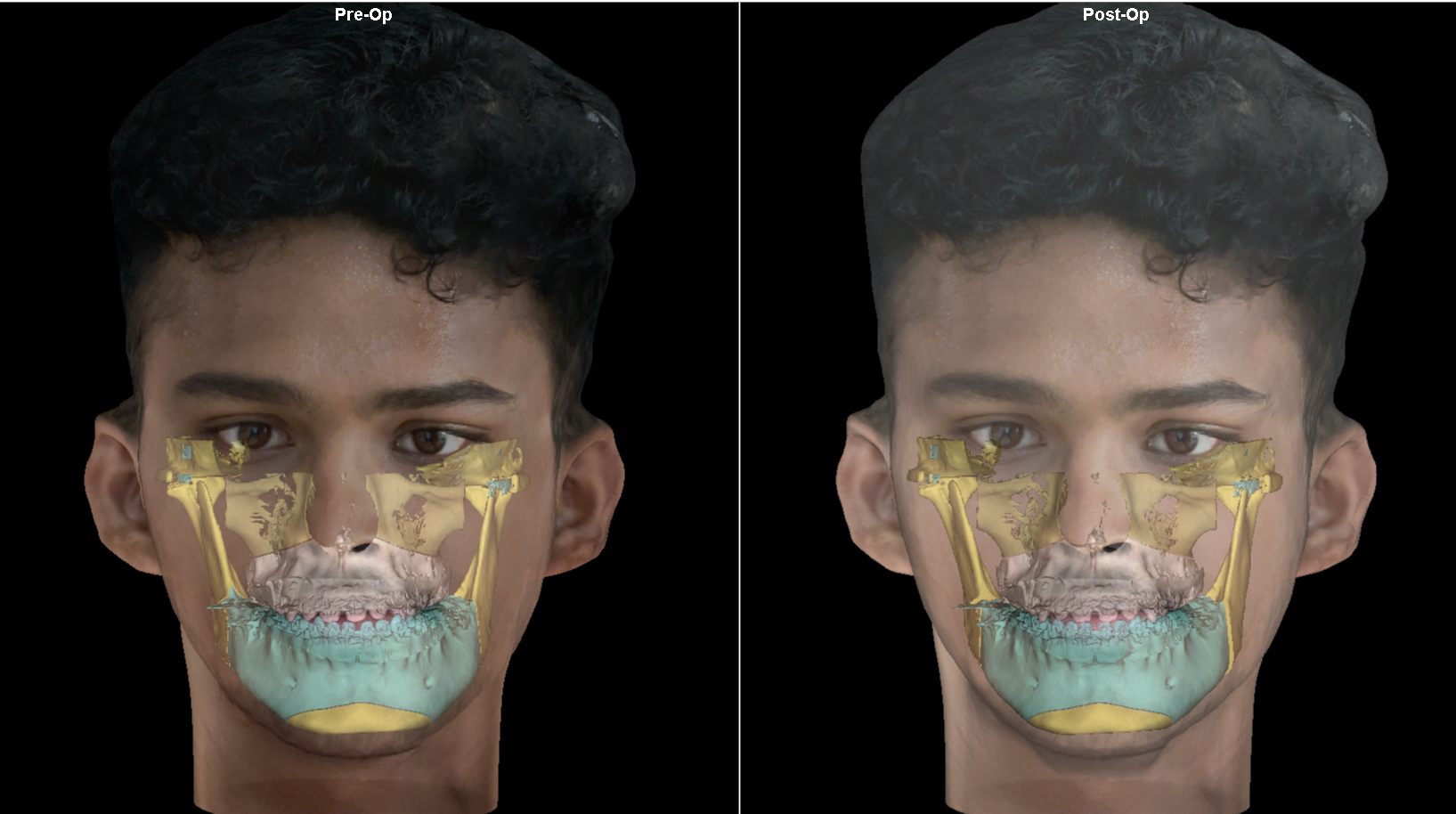 PRE AND POST SURGICAL EXTRAORAL DEPICTION