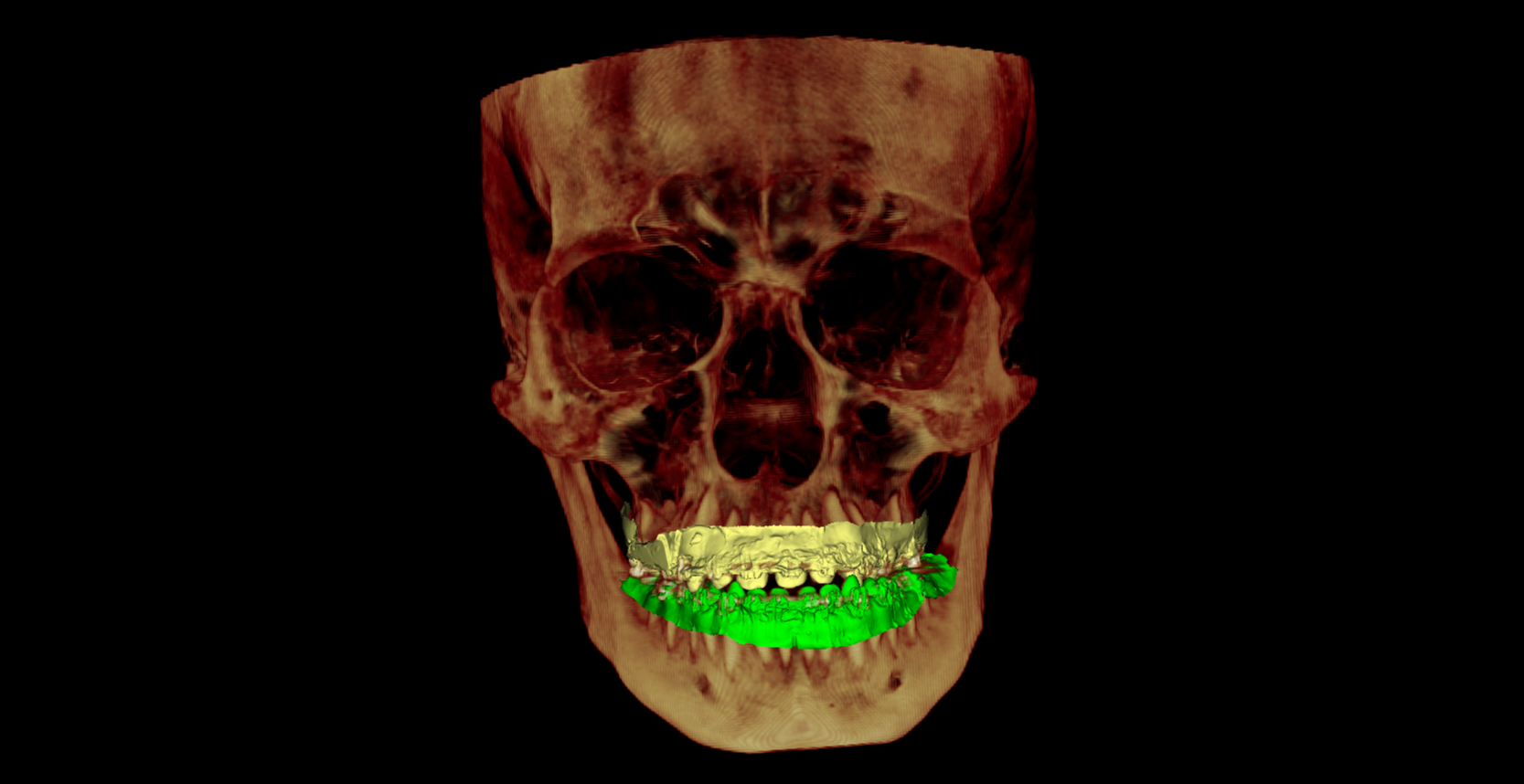 CBCT AND INTRAORAL MODEL SCANNING