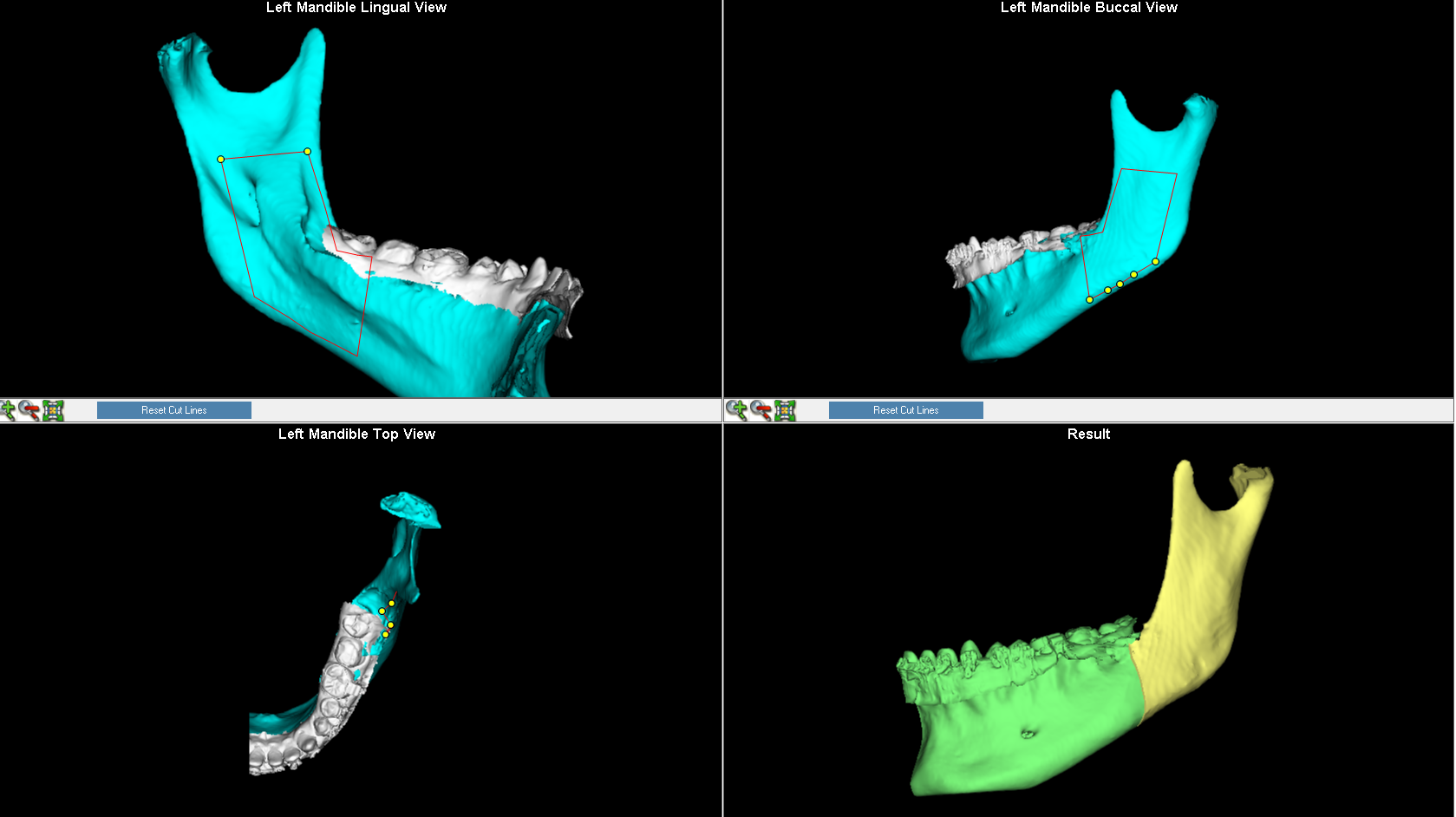 SURGICAL CUTS SIMULATED IN MANDIBULAR BONE