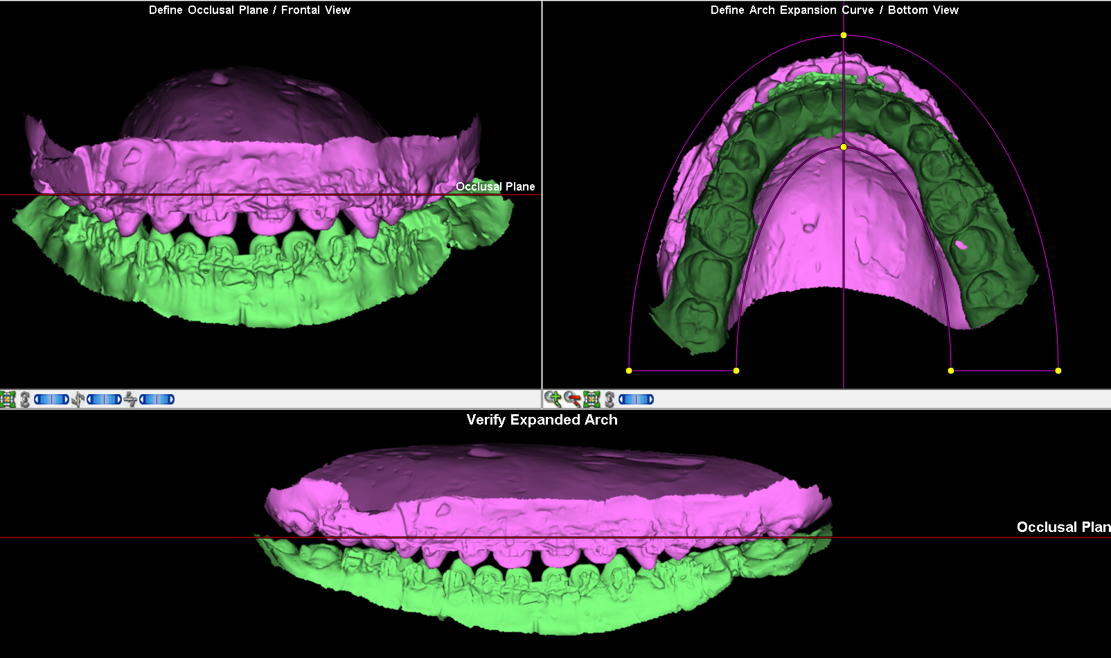 3D SPLINT FABRICATION