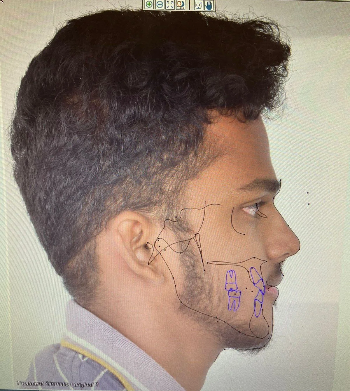 2D SURGICAL PLANNING