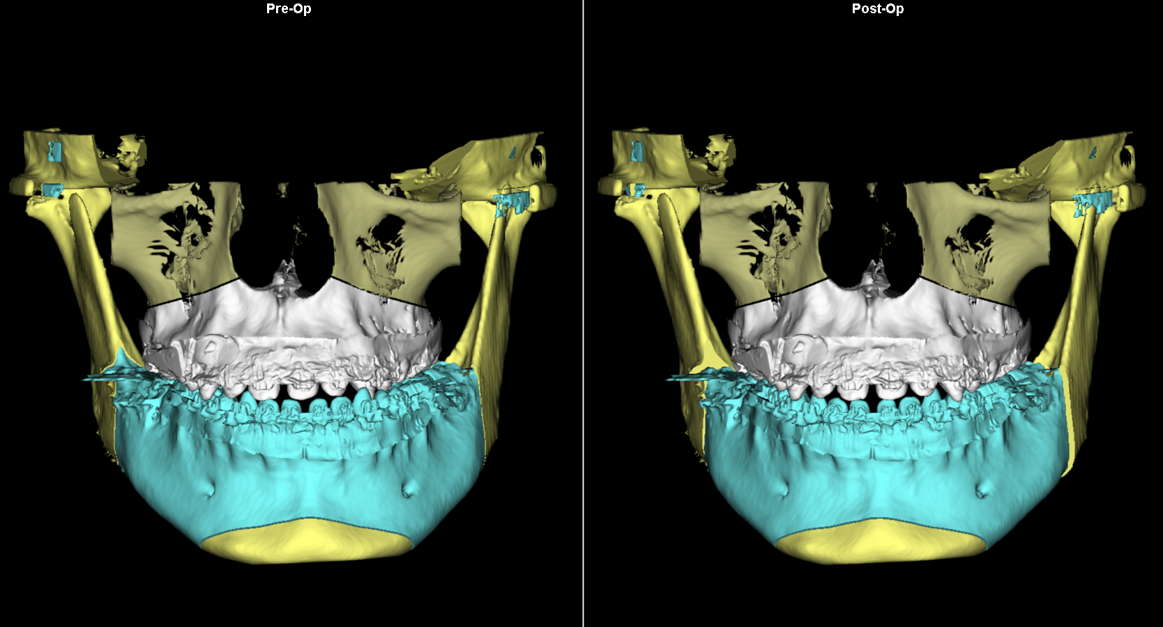 PRE AND POST SURGICAL DEPICTION OF INTRAORAL VIEW