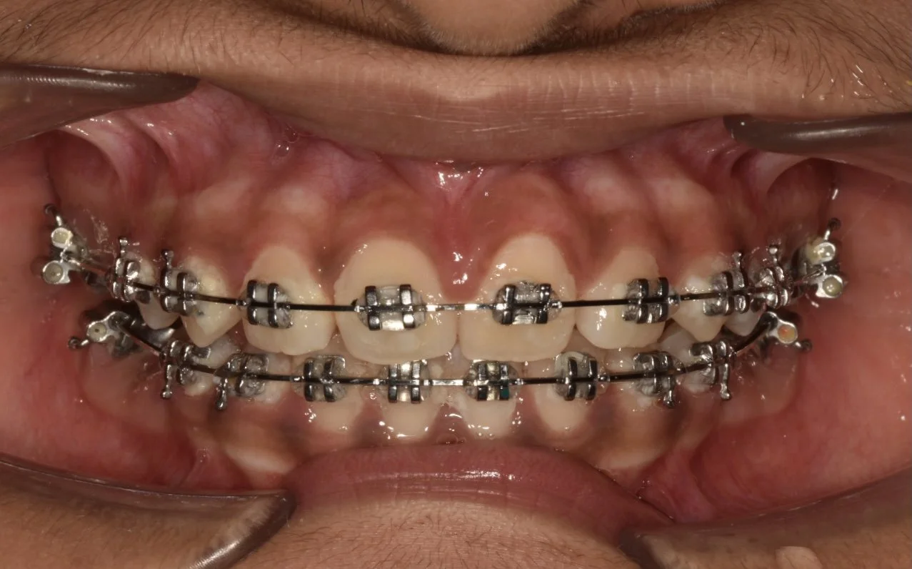 CORRECTION OF MAL-ALIGNMENT