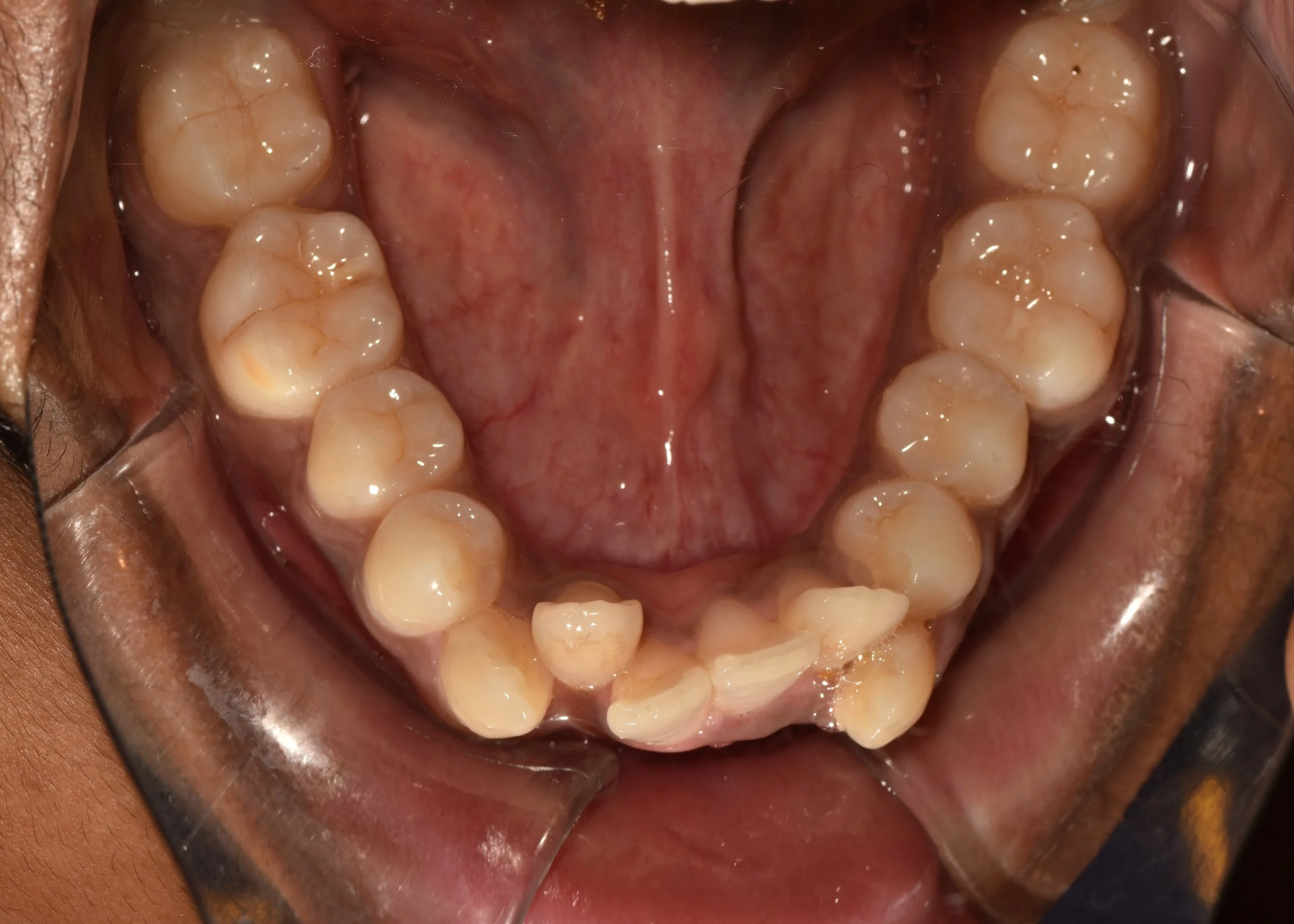 ALIGNEMENT CORRECTION