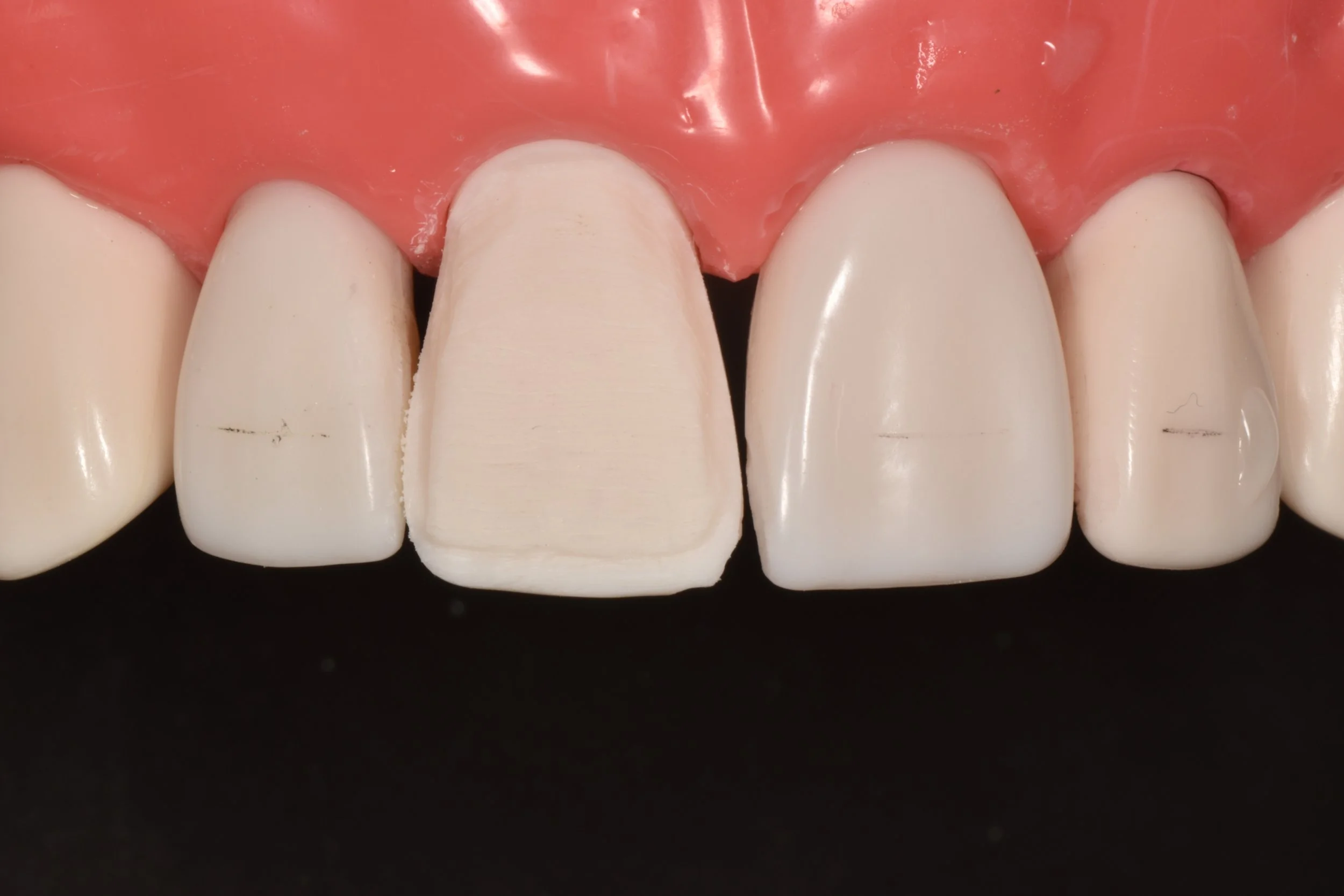 tamed in esthetic tooth preparation for crowns and veneers