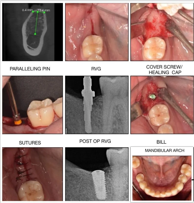 single implant placement technique
