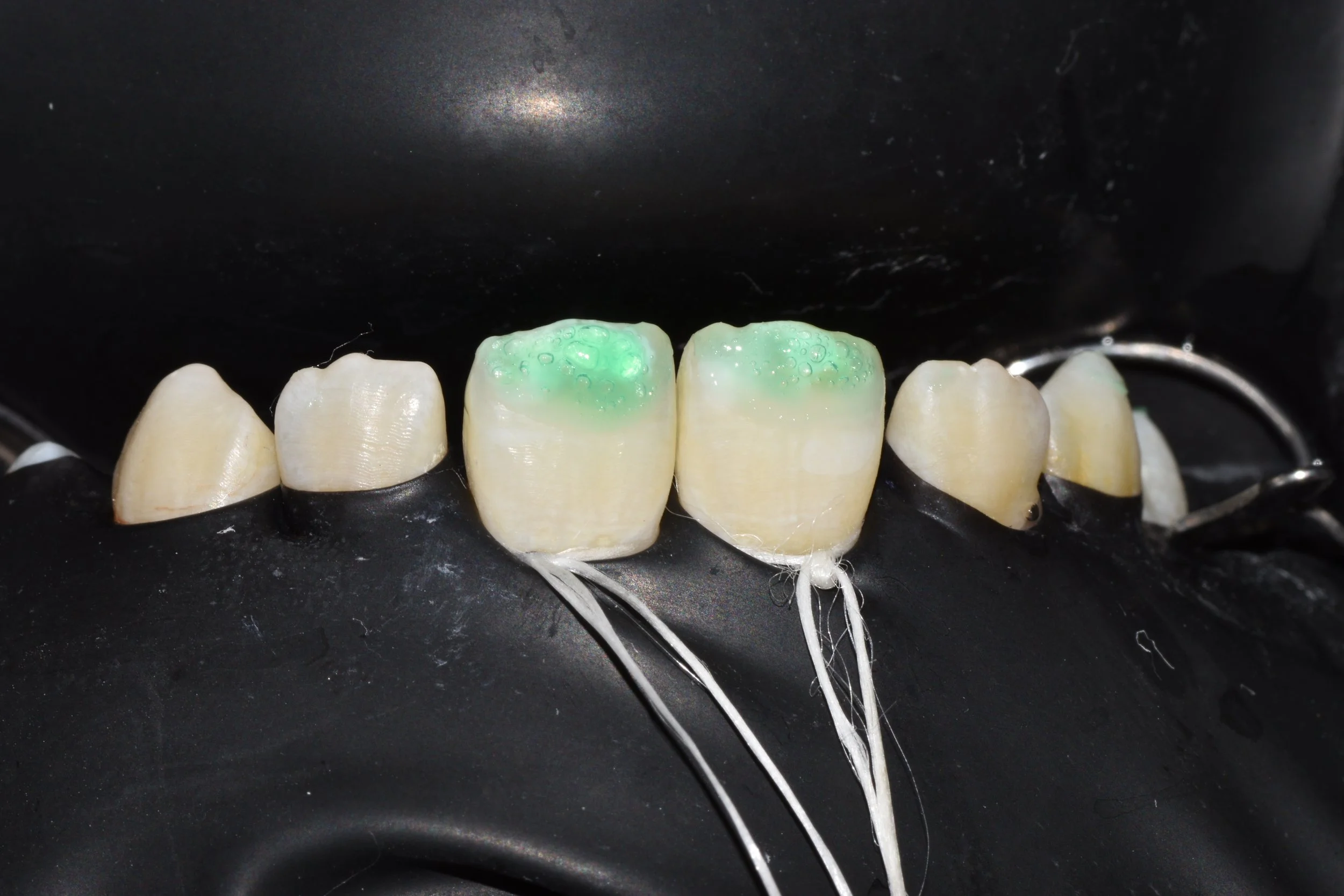 resin infiltration technique for prevention of early carious lesions