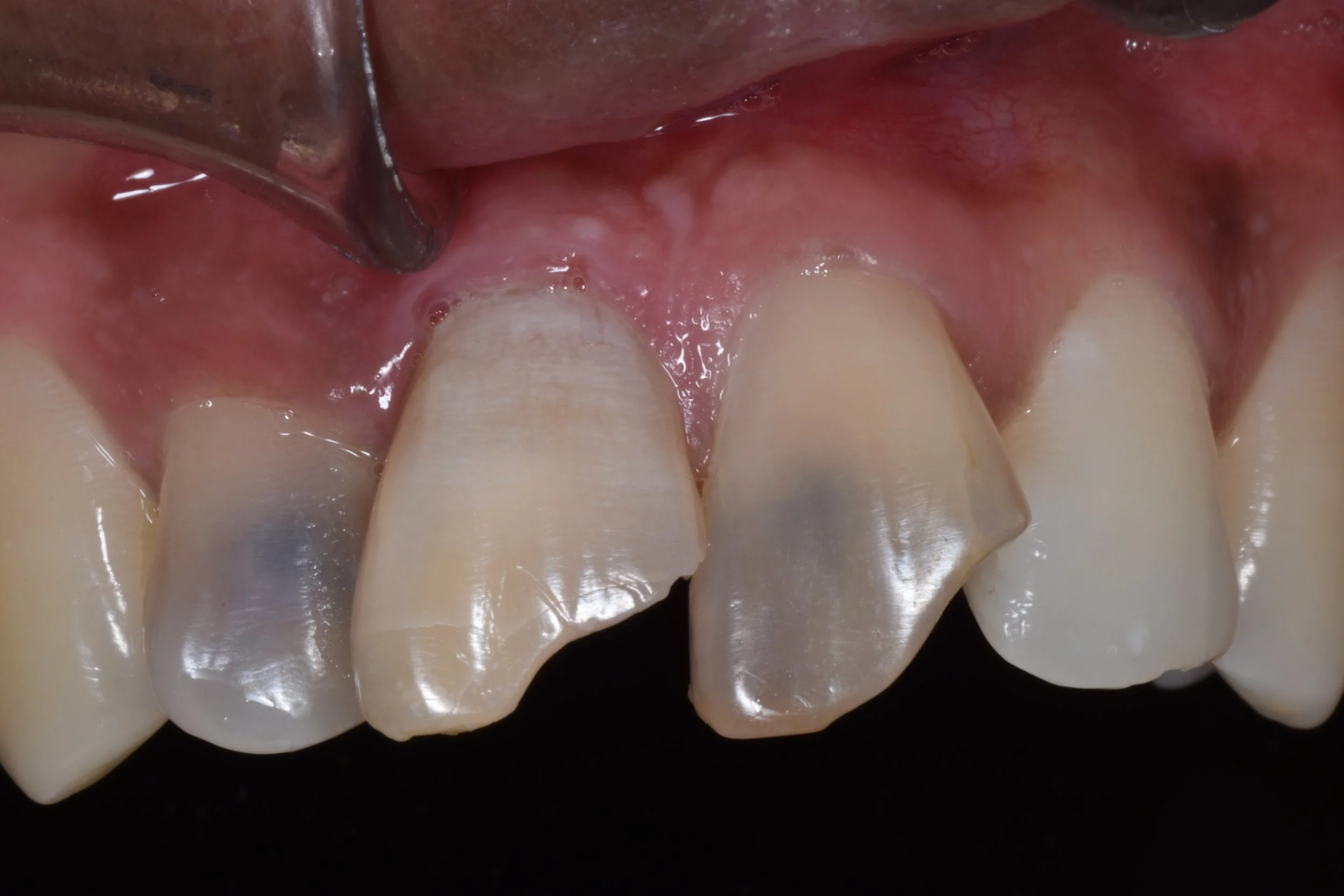 tooth whitening (Bleaching)