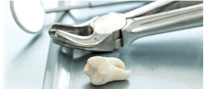 surgical extraction of impacted tooth