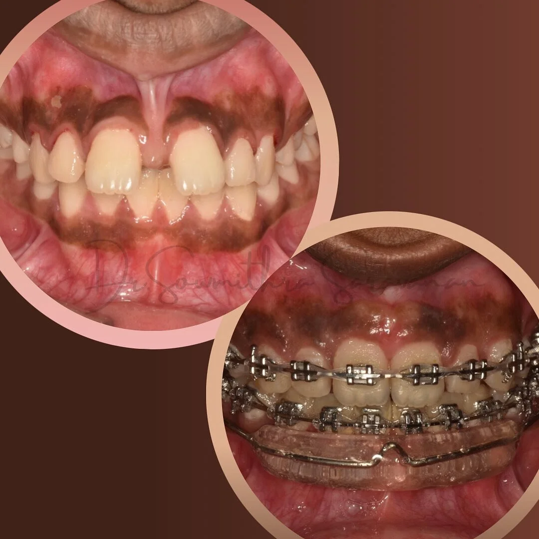 🦷&hellip;&hellip;..🦷 ⛓ 🦷🦷

#orthodonticspaceclosure