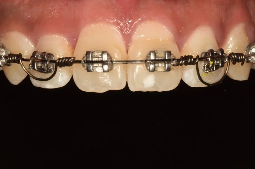 Hangin&rsquo; around!!

#torquingsprings