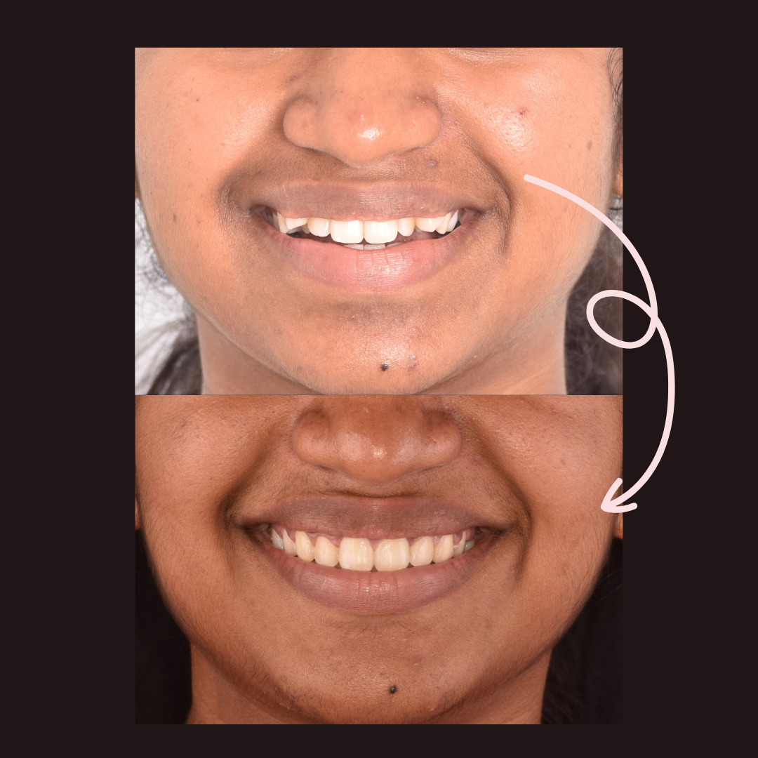 Orthodontic smile makeover - 2.PNG