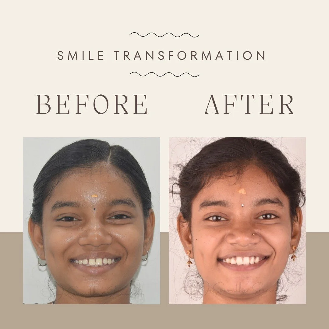 Smile transformation - 1.jpg
