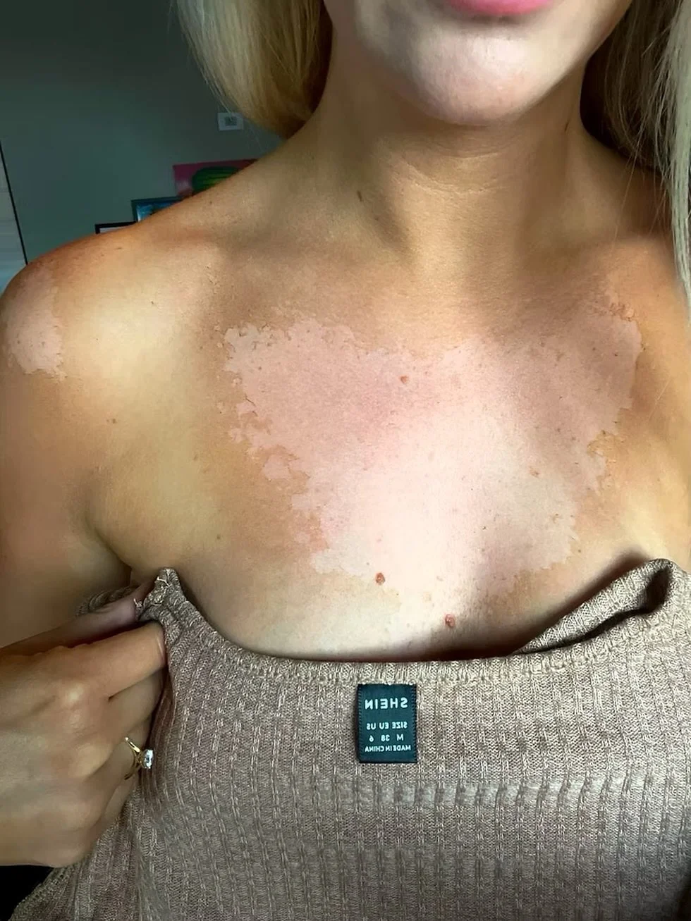 NOT MY WORK! Ladies, it&rsquo;s that time of year &mdash; when your spray tan tech asks you if you&rsquo;ve been sunburnt recently, this is why 🚨‼️ The active ingredient in spray tan solution can be very drying. When applied to damaged skin, this is