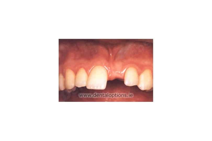 Step 1: Space where tooth is missing
