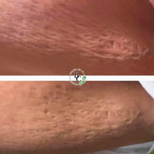 scar camouflage