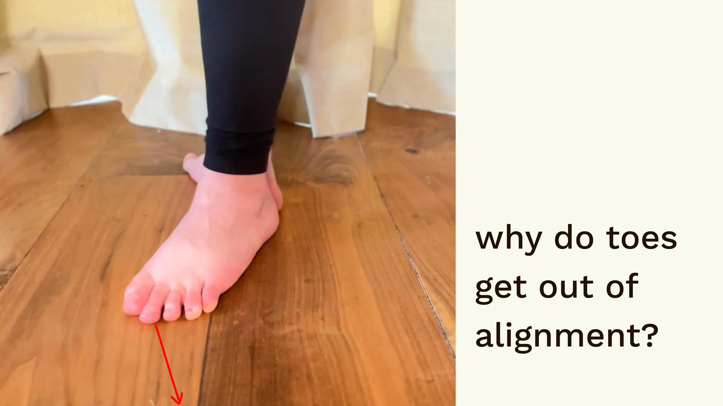 why do toes get out of alignment?