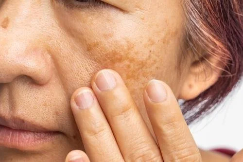 Melasma pregnancy hormones pigmentation