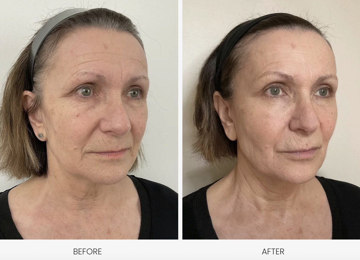 Side-by-side comparison of a woman's face before and after a dermal filler treatment in London or skincare treatment showing reduced wrinkles and improved skin texture.