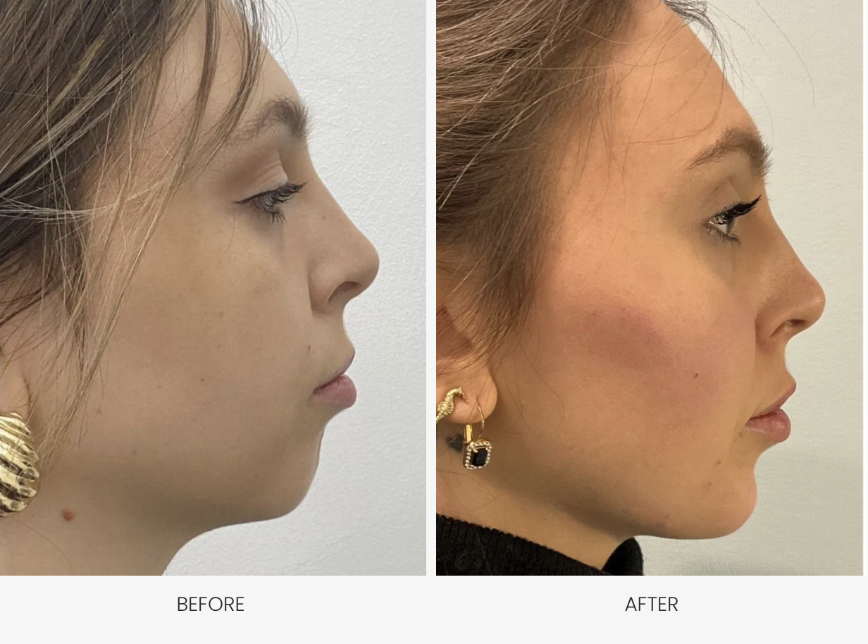 Side-by-side comparison of a woman's face before and after a cosmetic procedure. The 'before' image shows a woman with a non perfect profile balance. Dermal fillers were used to improve chin and lips definition and volume