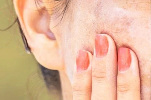 Pigmentation and Sun Damage, retinol, hydroquinone , obagi