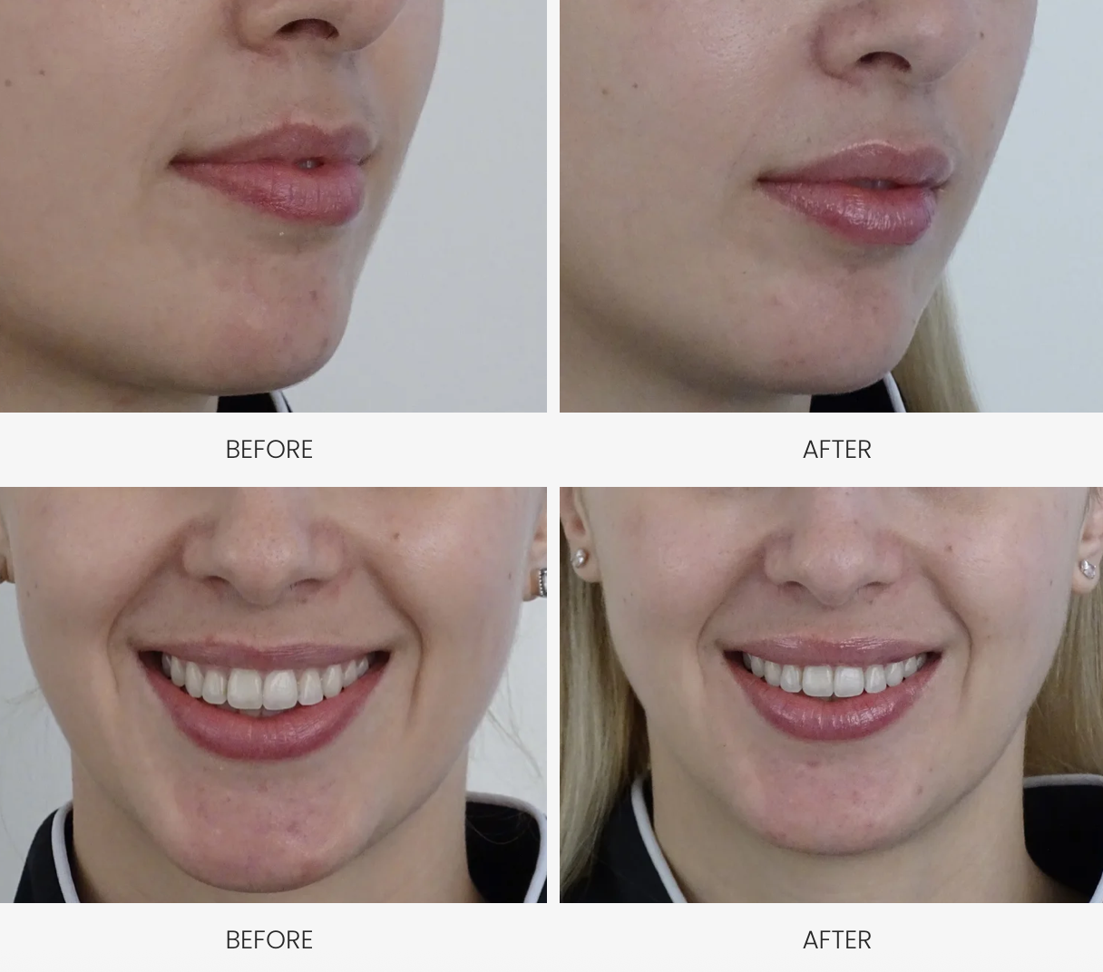 Comparison of two women's faces showing before and after cosmetic dental procedures, focusing on lips and smile after natural lip filler treatment