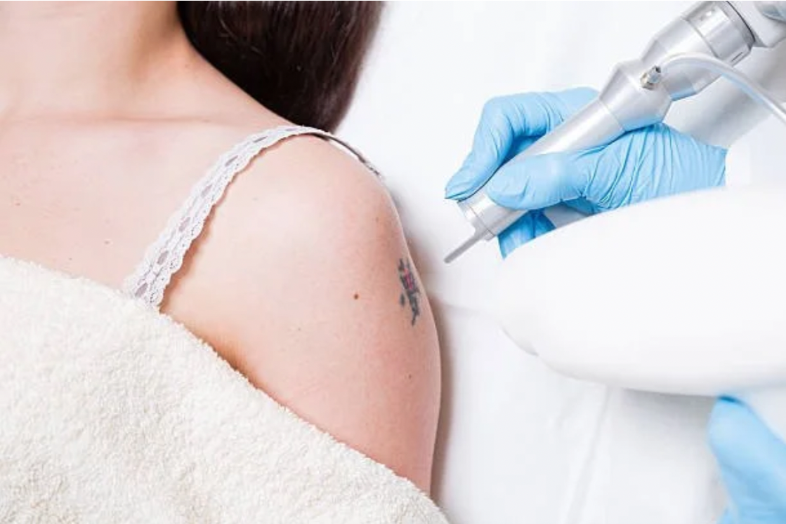 woman getting laser tattoo removal in Landisville