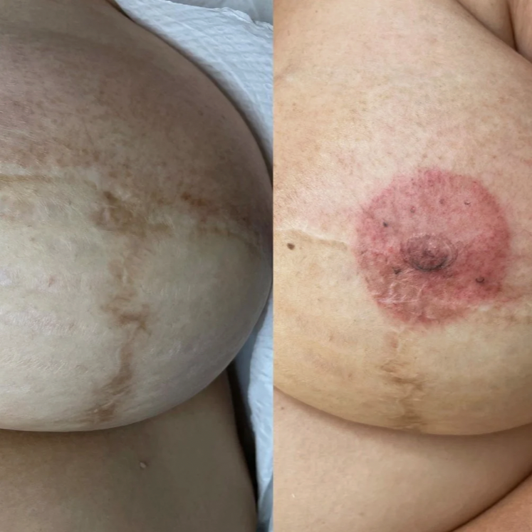 before and after of areola tattoo in Landisville